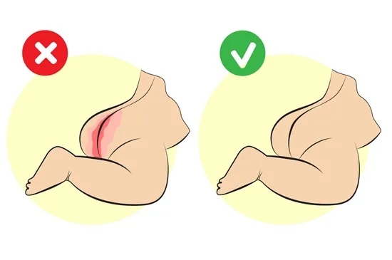 Jak wyglądają odparzenia u niemowlaka i jak im zapobiegać?